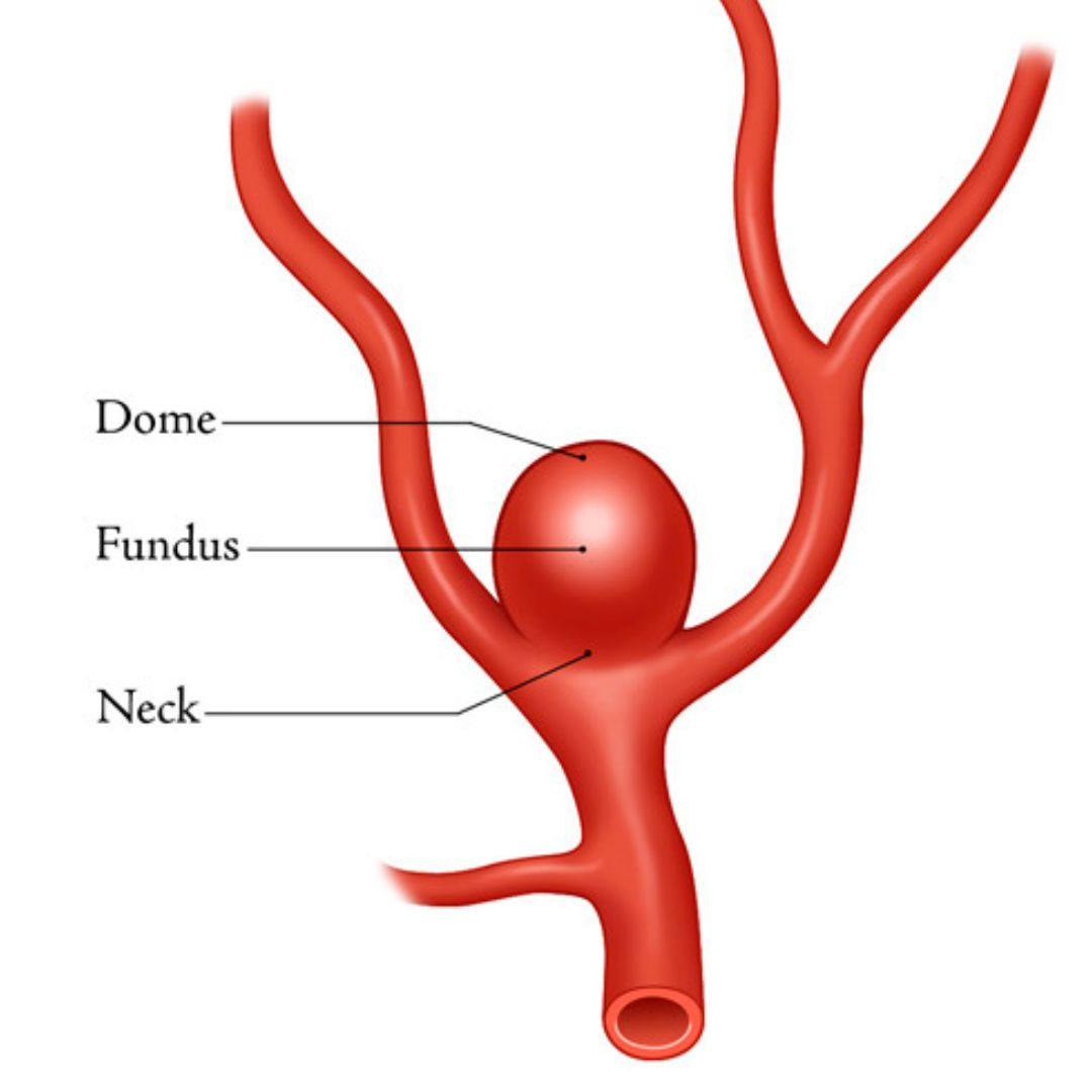 About Aneurysms
