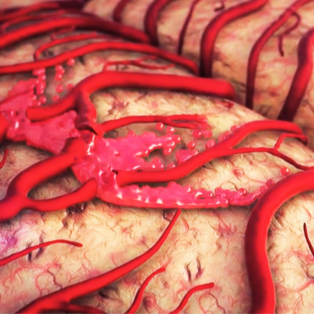 Aneurysms Causes