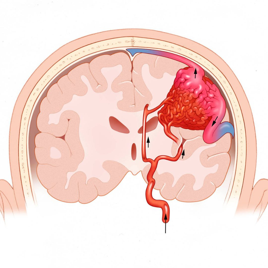 AVM Causes