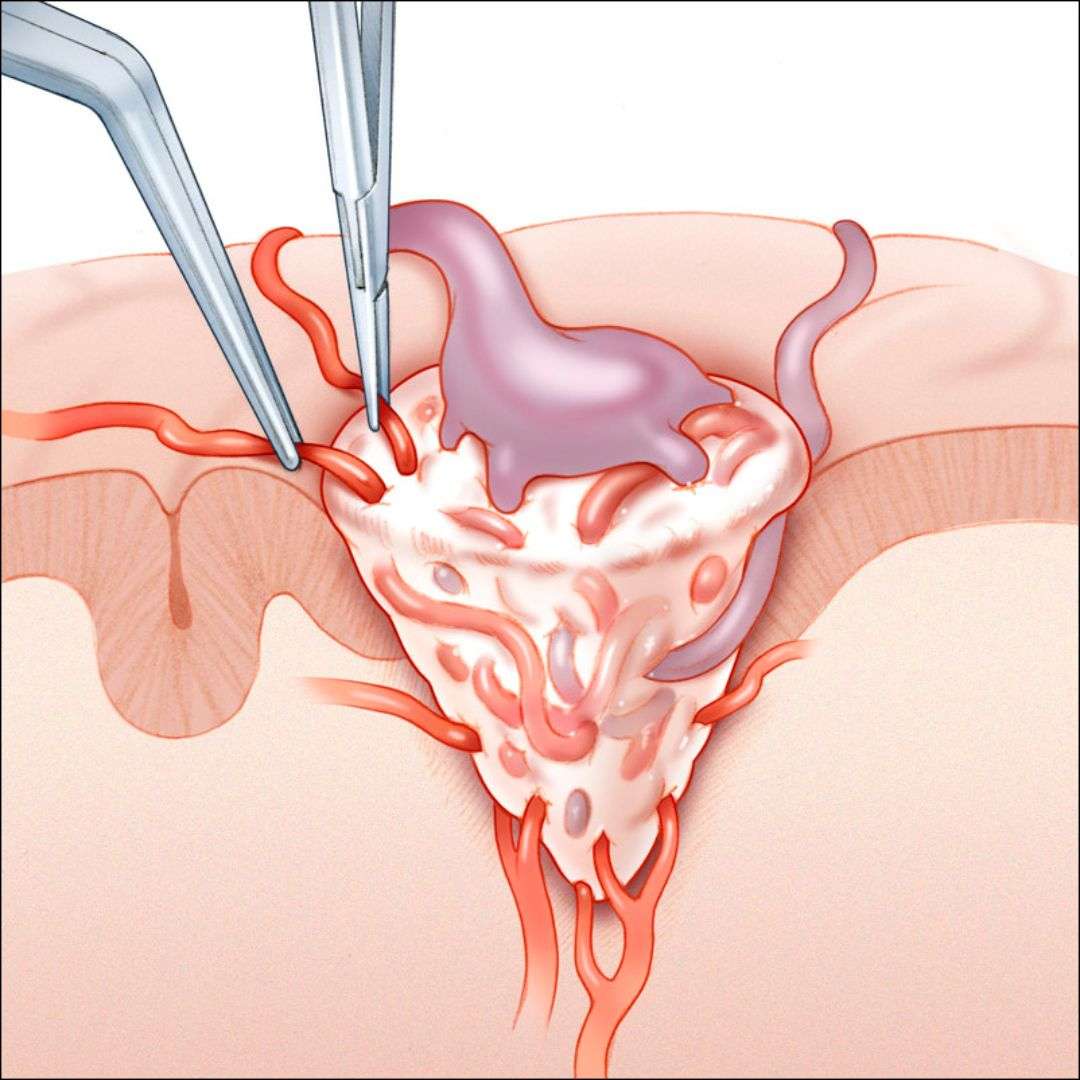AVM Treatment
